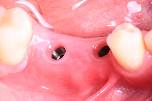 debrecen fogaszati implantatum.jpeg