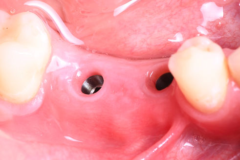 debrecen fogaszati implantatum.jpeg