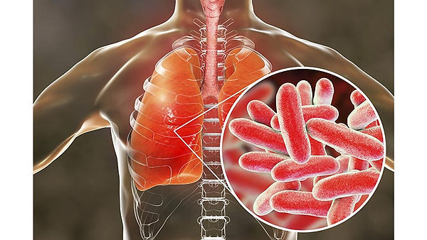 Legionella chest infection