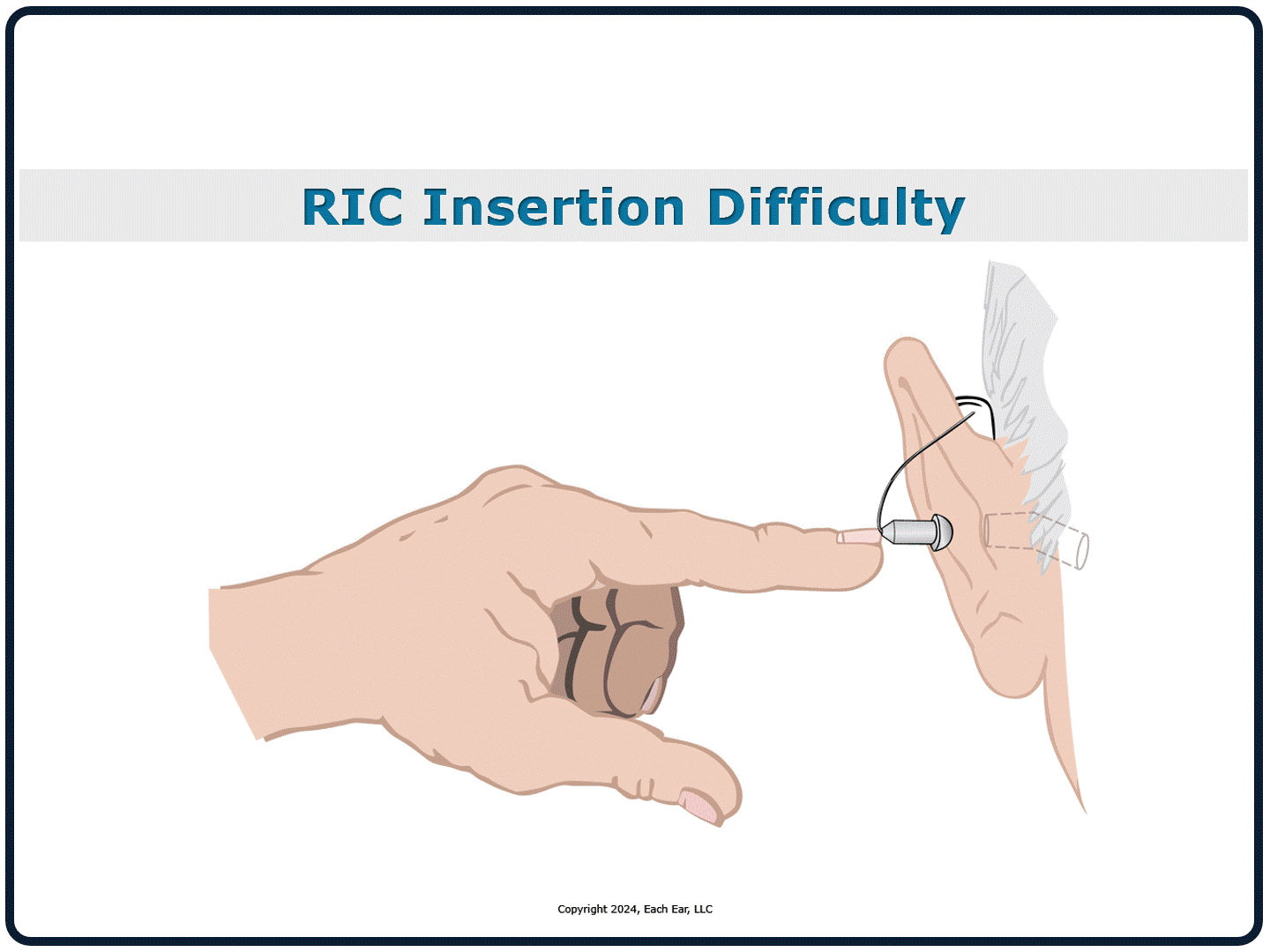 RIC Insertion Difficulty.gif