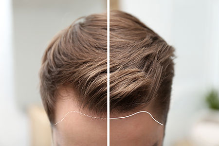 Hair transplant mini.jpg