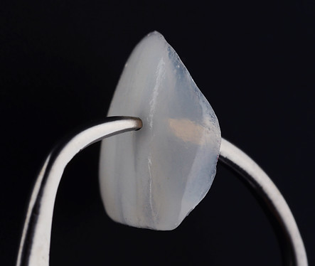 Ultra thin veneers.jpg
