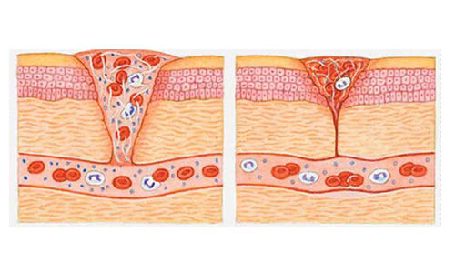 diyabet hastalari icin yara iyilesmesi sureci nasil olur