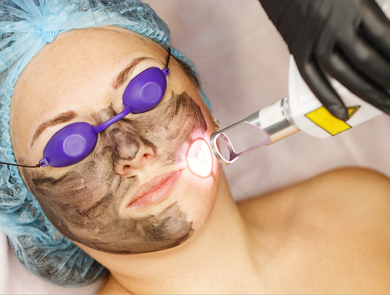 Carbon_Facial_Treatment-1.png