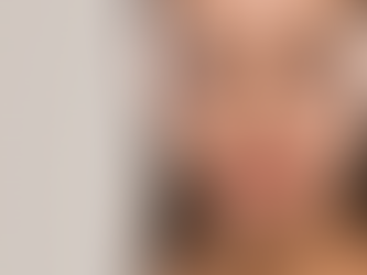 Are Belotero Fillers Safe for First-Time Patients