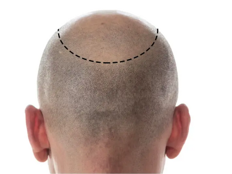 Is Scalp Micropigmentation a Painful Process?