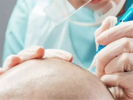 Does Scalp Micropigmentation Look Natural?