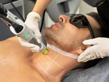 What Are Benefits of Beard Laser Hair Removal?
