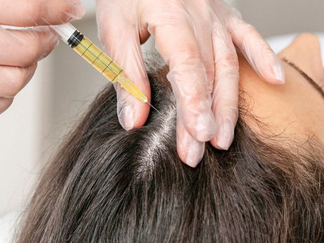 Is PRP Treatment Good for Hair Regrowth Needs