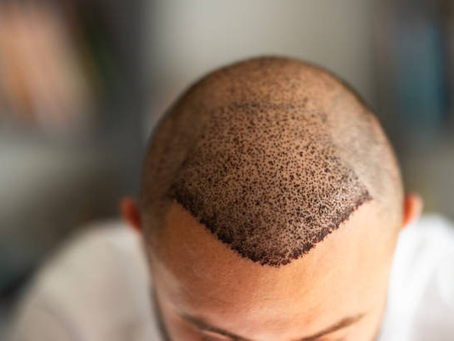 Is Hair Replacement Safe for Sensitive Scalps?
