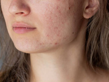 How Long Does Acne Treatment Last After Sessions?