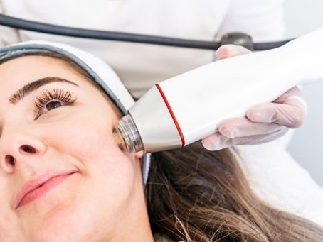 What RF Microneedling Does for Acne Scars
