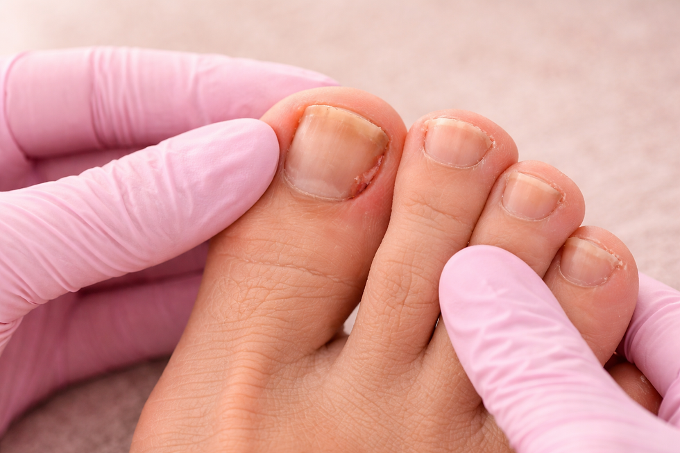 ingrown management