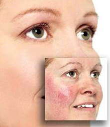 הטיפול ברוזציאה