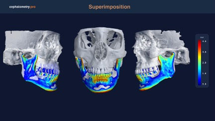 CBCT Before and After Cranial and SOT Treatment
