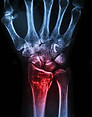 pngtree-fracture-distal-radius-wrist-bonecolles--fracture-surgery-science-medicine-photo-i