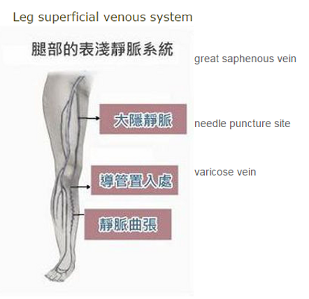 ENDOVENOUS LASER ABLATION (EVLA)