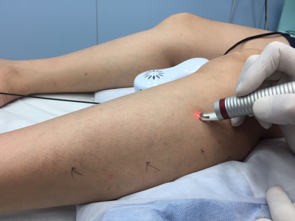 下肢靜脈曲張常見症狀與鑑別診斷 Common symptoms of varicose veins and differential