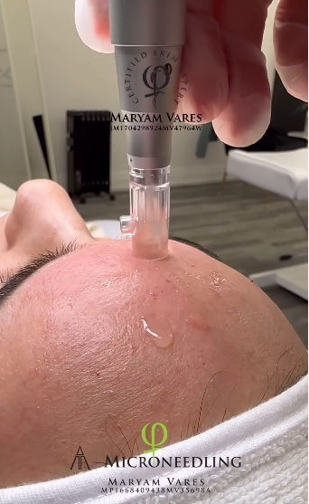 Microneedling: Health Benefits & Risks