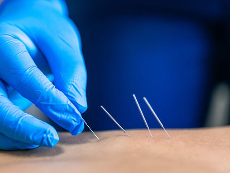 How Dry Needle Therapy Near Me Relieves Pain Fast