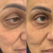 Reejuvenate -  Plasma full eye results 