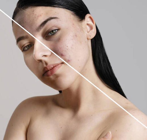 Аппарат Vmax Hifu в EDEN AESTHETICS
