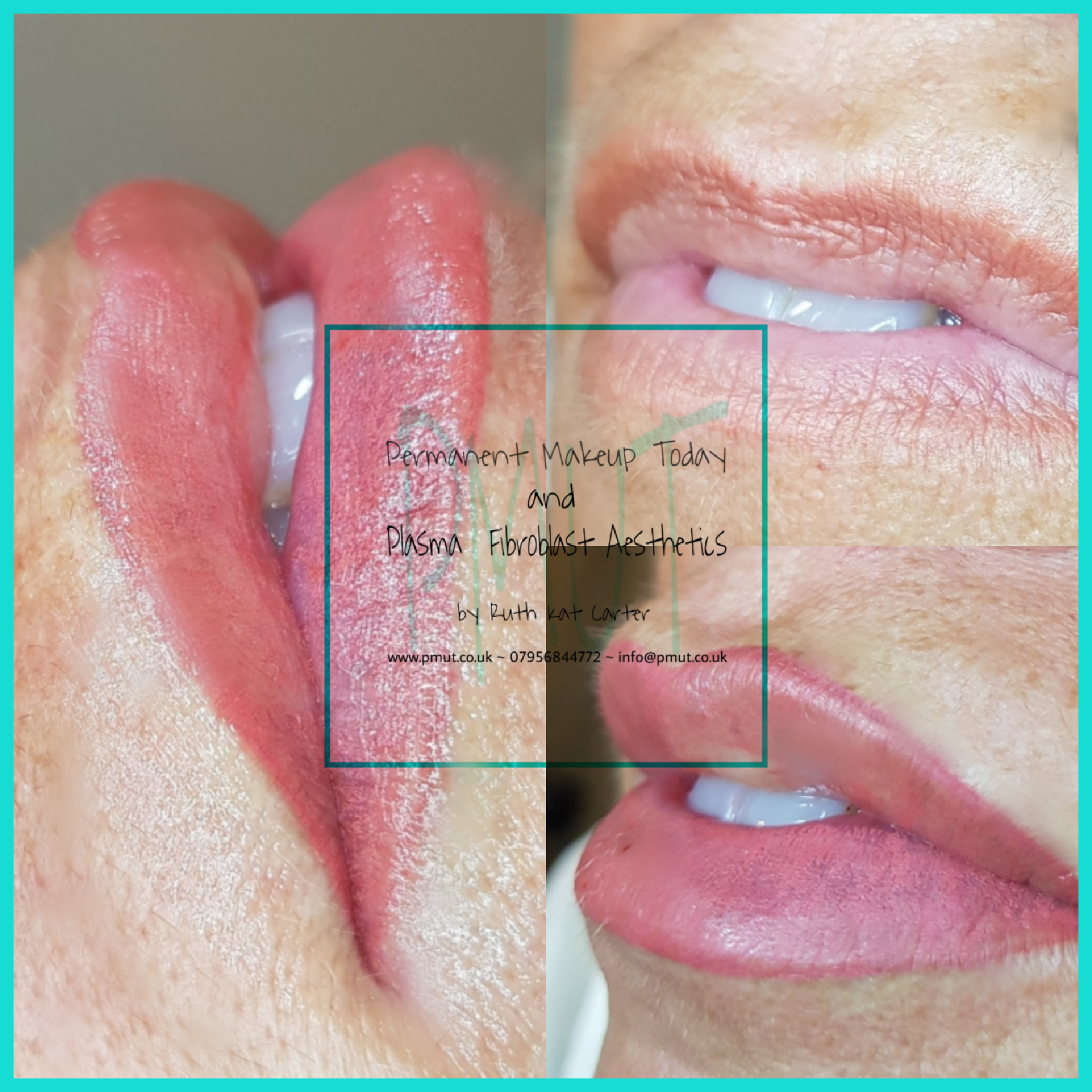 Lip Procedure