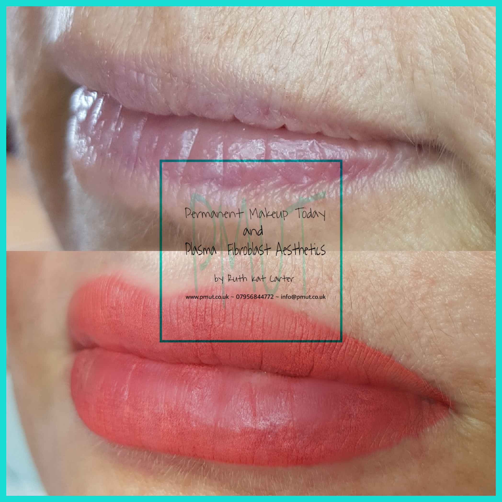 Lip Procedure