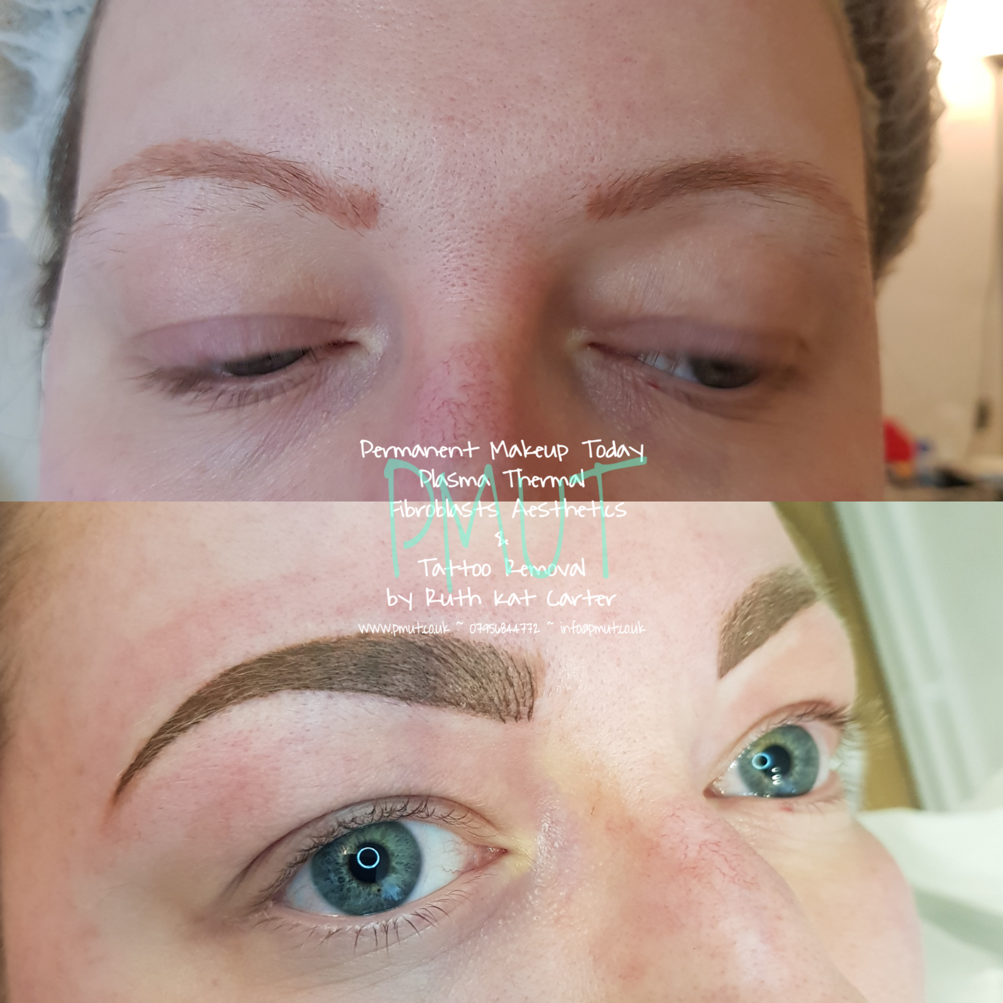 Brows Procedure