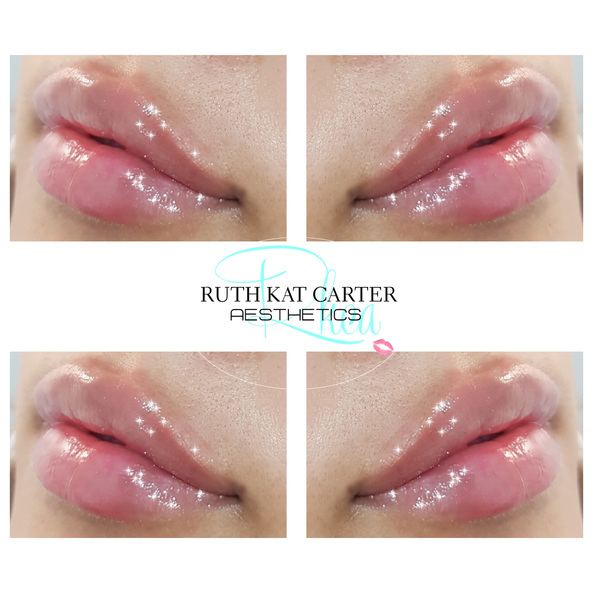 Lip Fillers