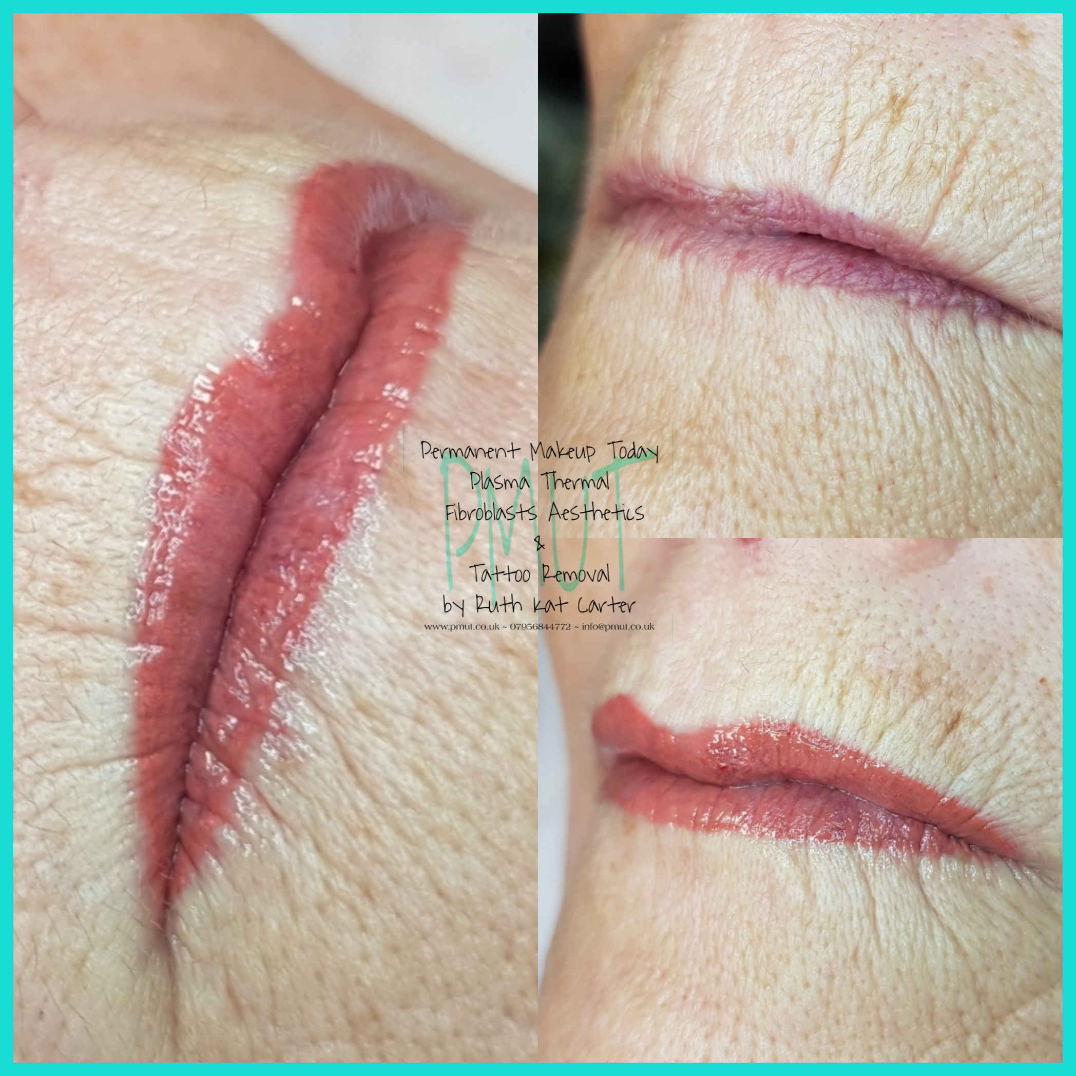 Lip Procedure