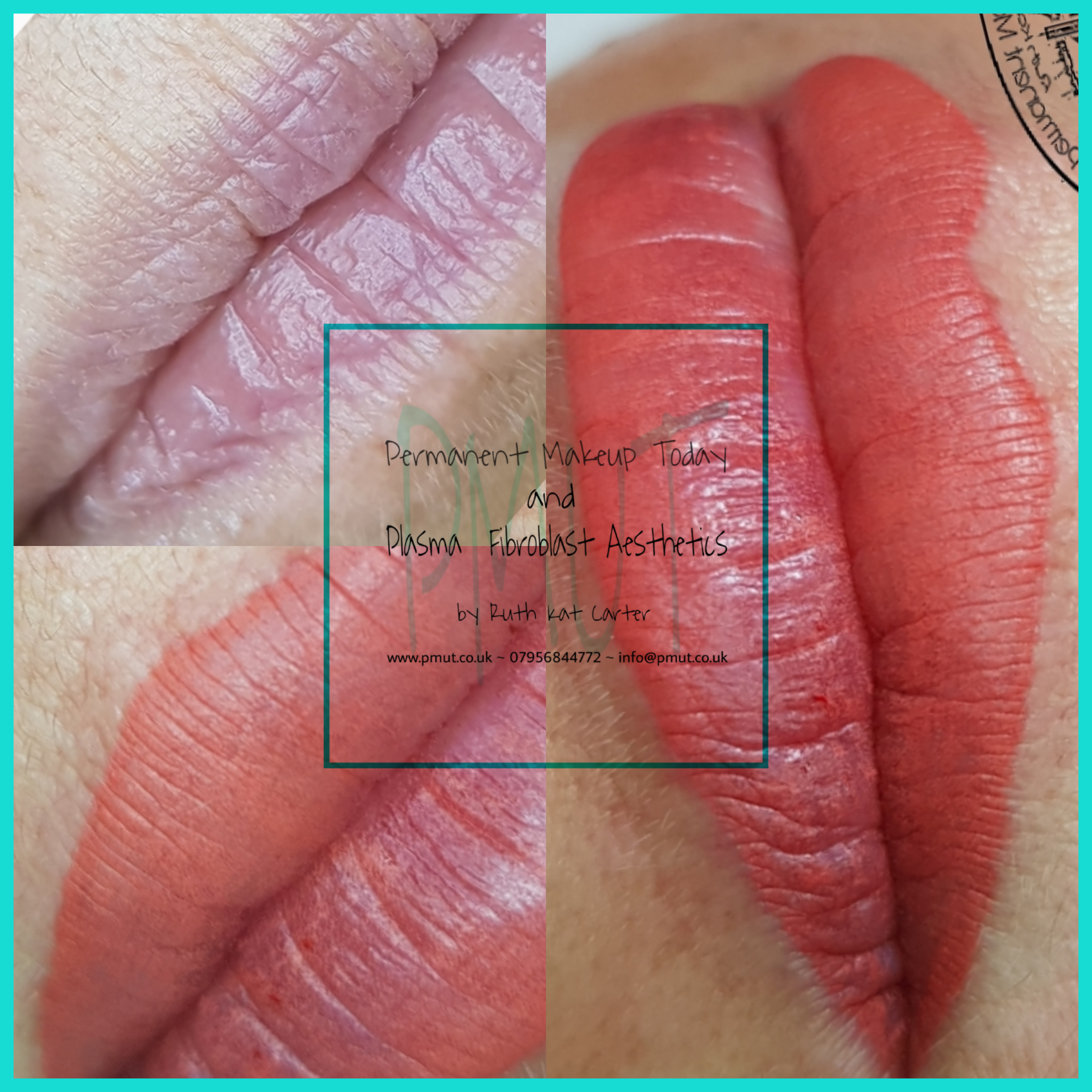 Lip Procedure
