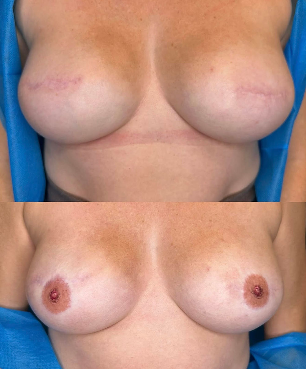 3D Areola Tattoo