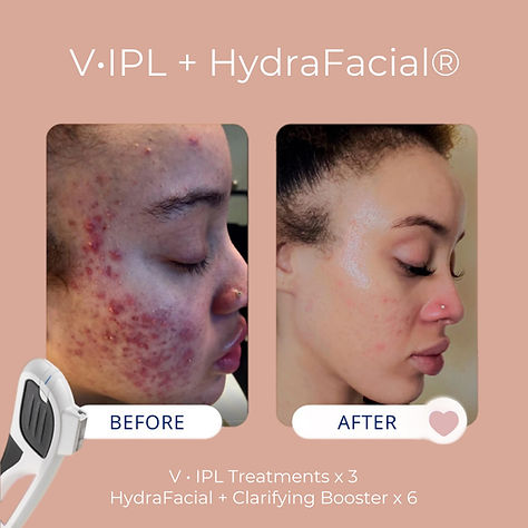 Before and After IPL