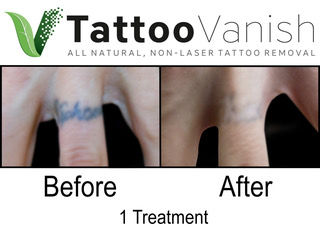 Ring Band 1 Treatment.jpeg