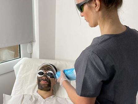 CARBON LASER FACIAL