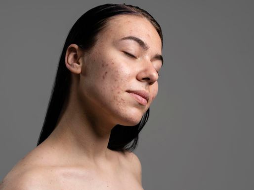 Isotretinoína (Roacutan®) aumenta o risco de depressão e ansiedade?