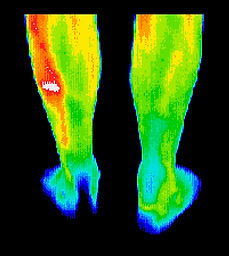 Football-player-with-stress-fracture.jpg