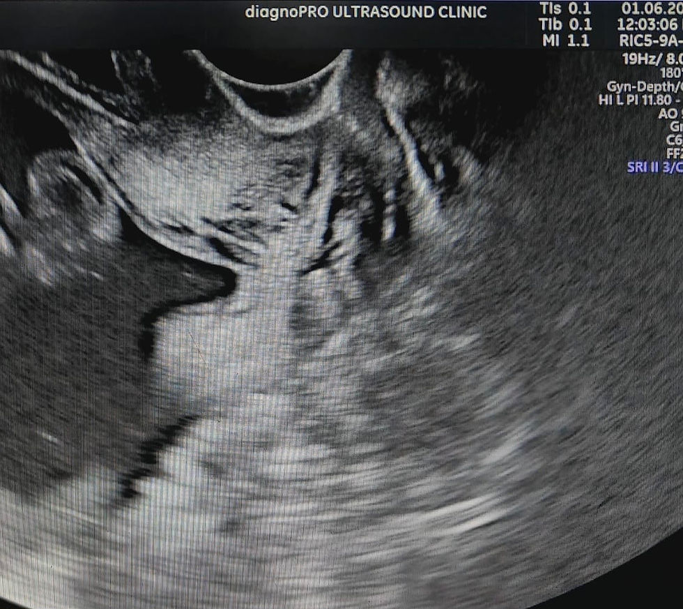 TVS ultrasound revealing short cervical length with cervical funneling