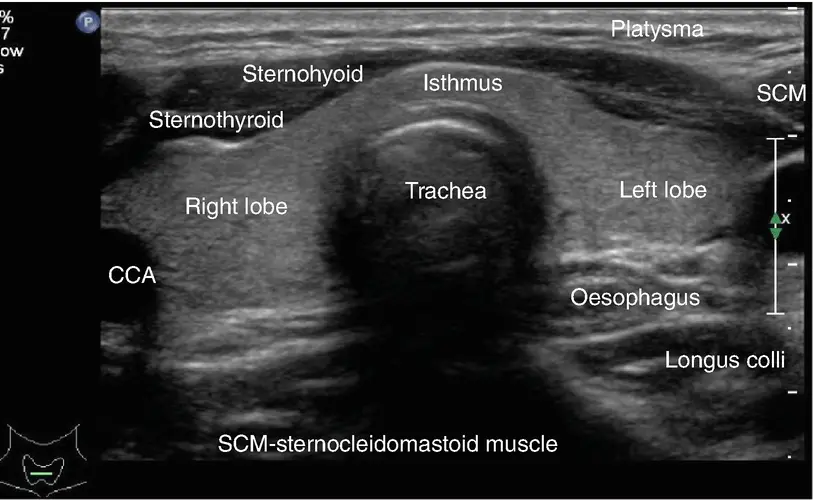 Close-up view of a thyroid ultrasound scan on a medical monitor