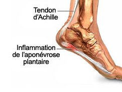Aponévrosite plantaire | Talalgies