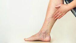 Varicose Vein