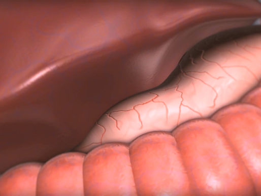Video Animation of a hiatal hernia operation showing the Löhde-Procedure