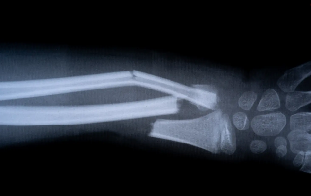 Chinese scientists have developed a solution that can fuse broken bones within 3 minutes using a single injection