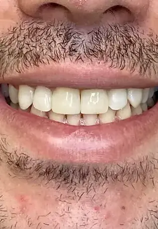 Бондинг, случай на бондинг, след лечението