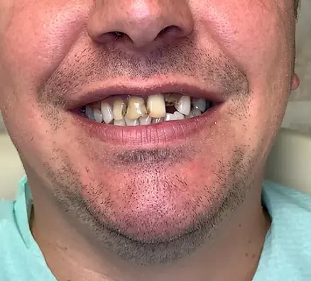 дентална естетика, поставяне на коронки, лечение на кариес, преди лечението