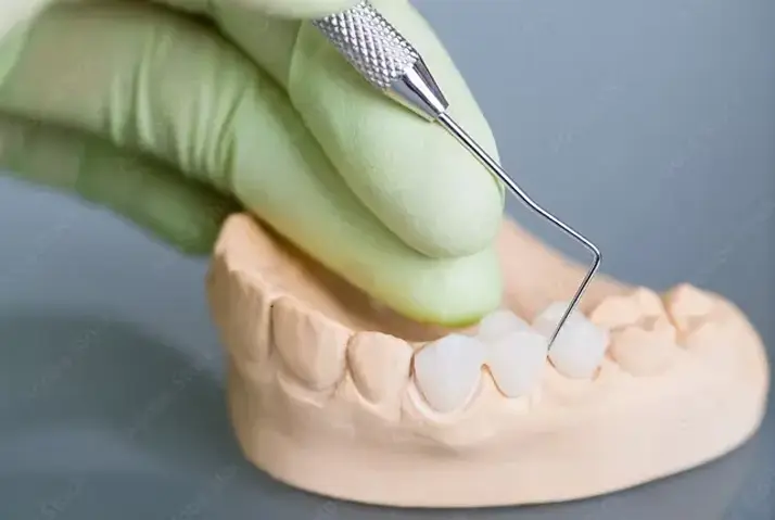 дентални мостове