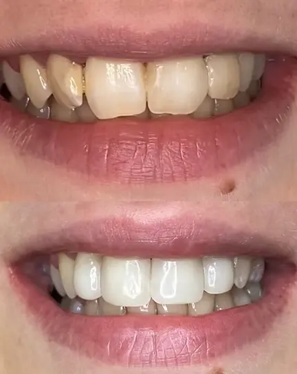 Бондинг, случай на бондинг, преди и след лечението