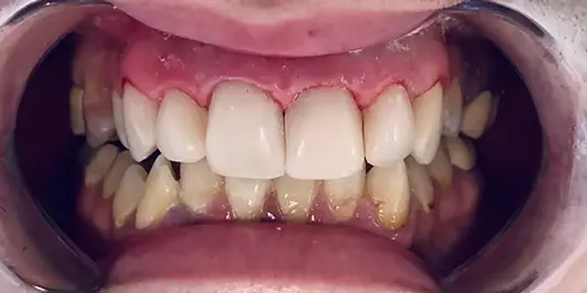 Бондинг, случай на бондинг, след лечението