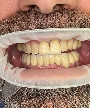 дентална естетика, поставяне на коронки, пълна промяна, след лечението